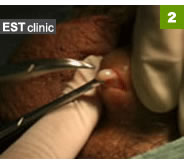 2. パイプカット術中、陰のう