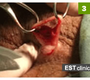 3. パイプカット術中、陰のう