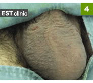 4. パイプカット術中、陰のう