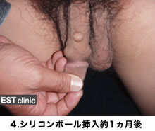 4.ｼﾘｺﾝﾎﾞｰﾙ挿入1ヶ月後
